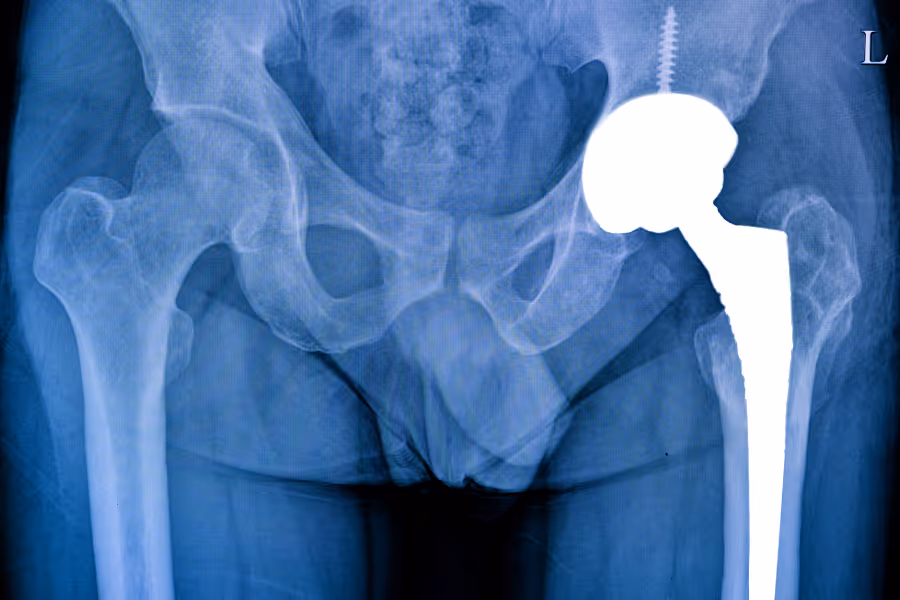 Xray showing an artificial hip