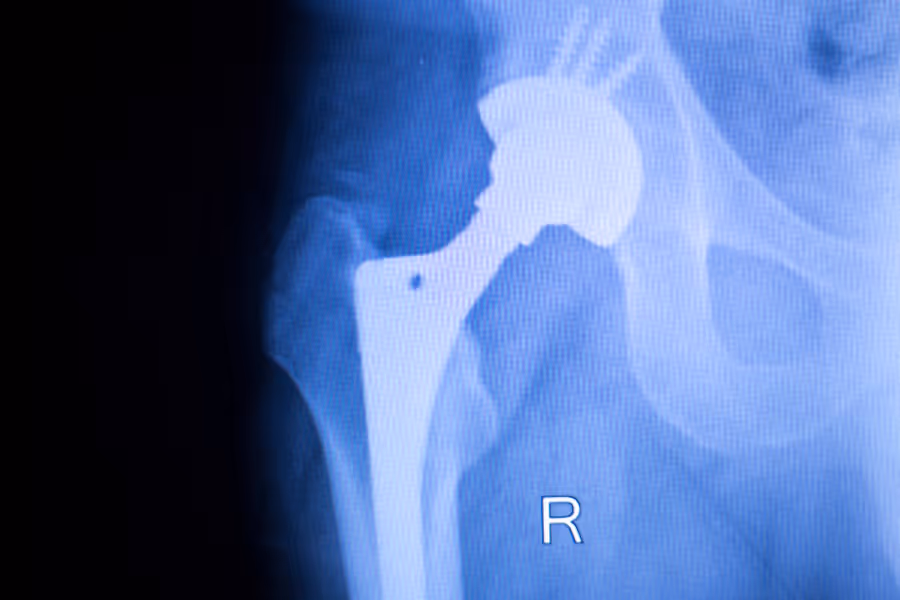 Xray showing hip replacement