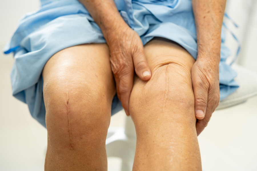 Woman on hospital bed showing her knees with old scars from bilateral knee replacement surgery
