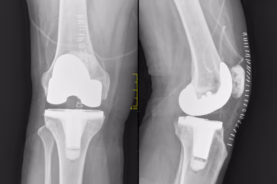 Xray showing total knee replacement