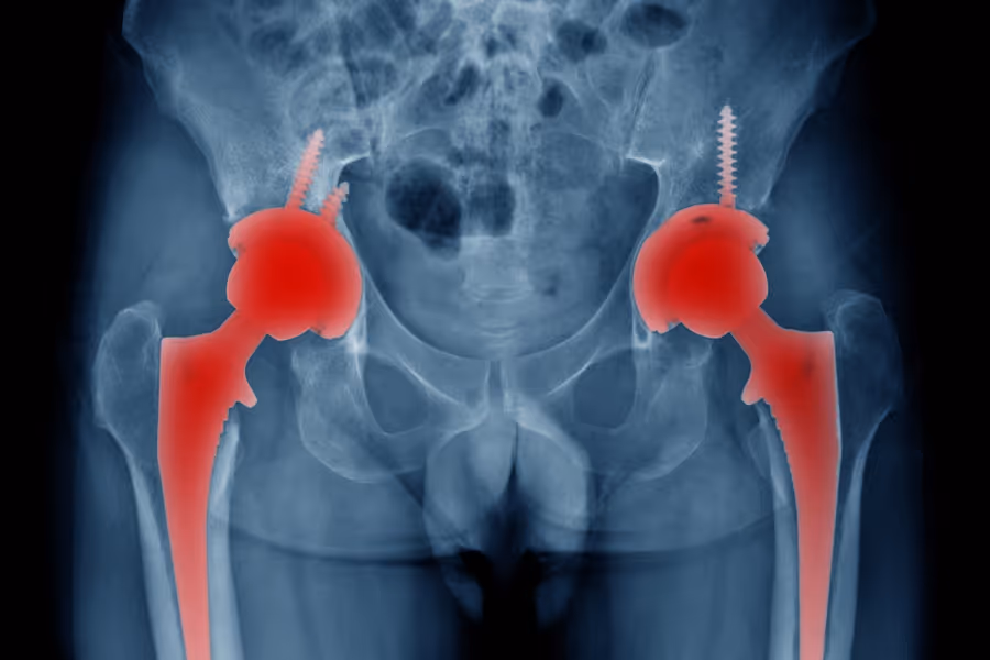 Xray showing a bilateral hip replacement