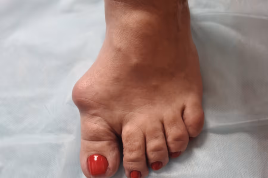 Painful, swollen big toe joint needing surgery