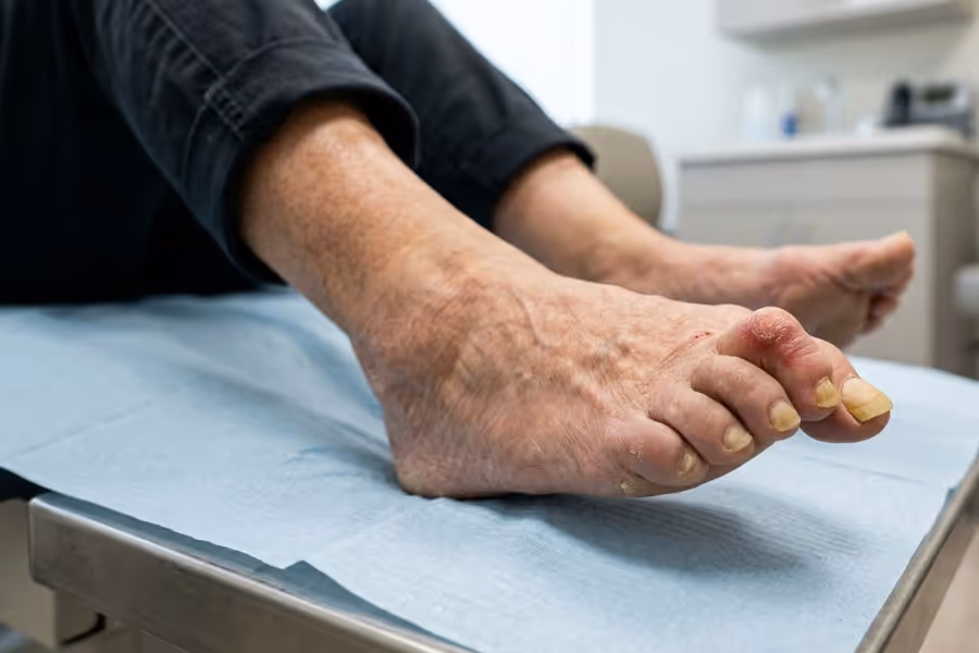 Closeup of mallet toe