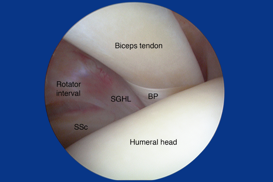Closeup of the biceps tendon meeting the shoulder joint