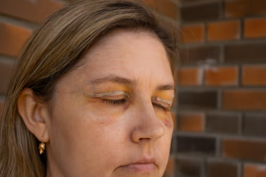 Woman's eyelids post surgery