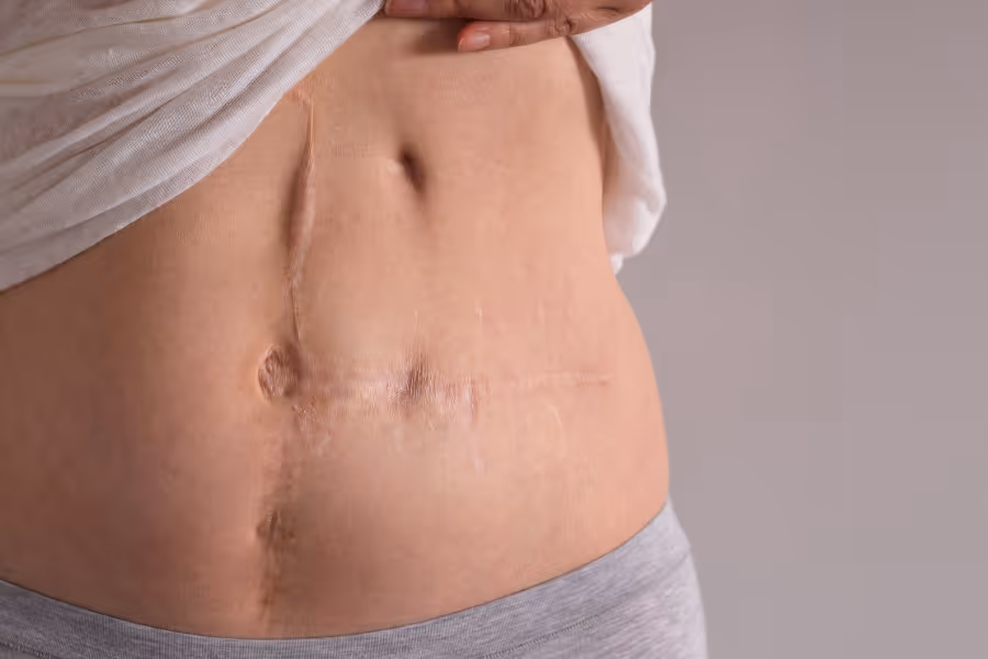 Woman with long healed surgical scars