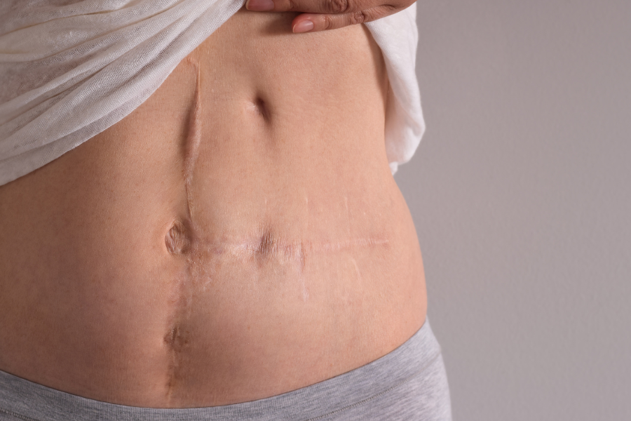 Woman with long healed surgical scars