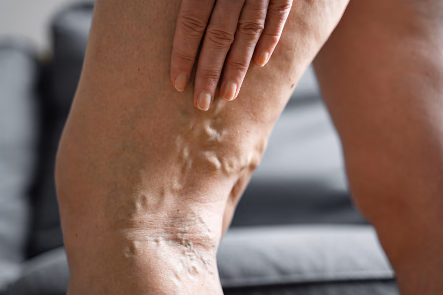 Woman holding behind her knee, showing her varicose veins