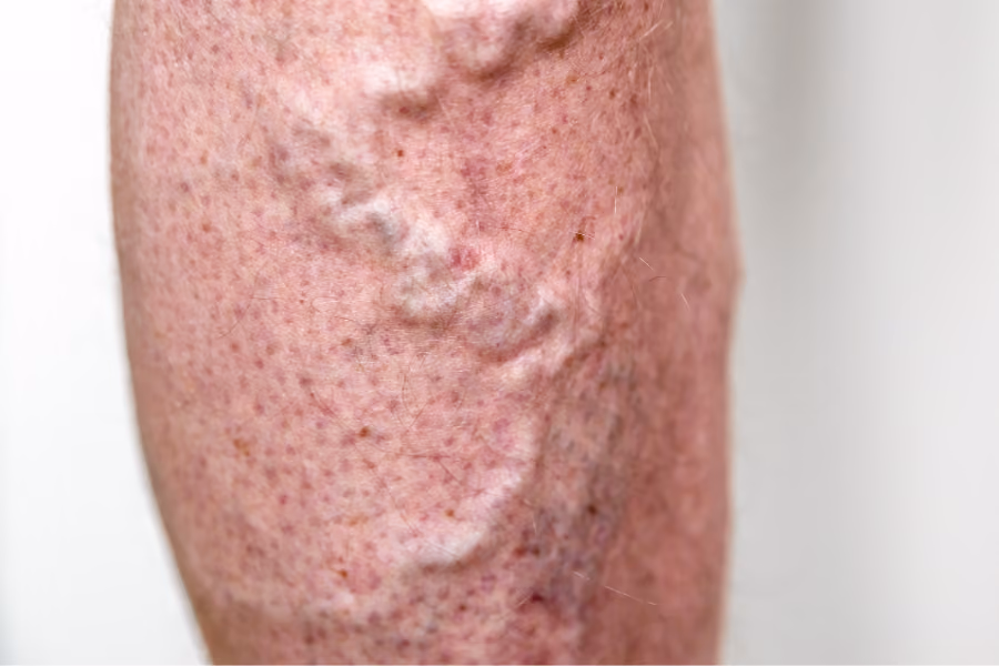 Thick, bulging varicose veins on calf