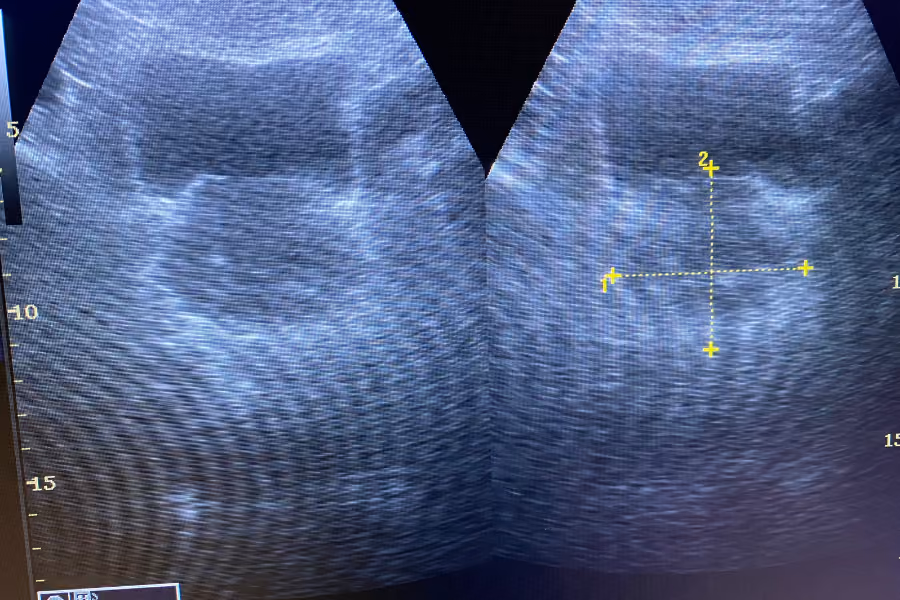 Xray showing visibly enlarged prostate