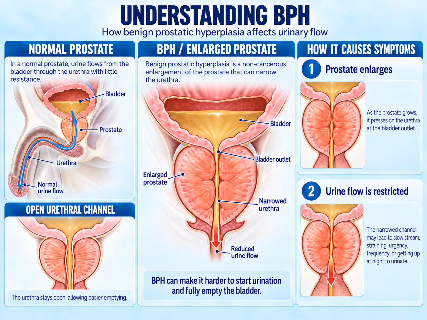 Infographie médicale expliquant l'hyperplasie bénigne de la prostate (HBP), comparant une prostate normale à une prostate hypertrophiée et montrant comment l'hypertrophie de la prostate peut rétrécir l'urètre et restreindre le flux urinaire.