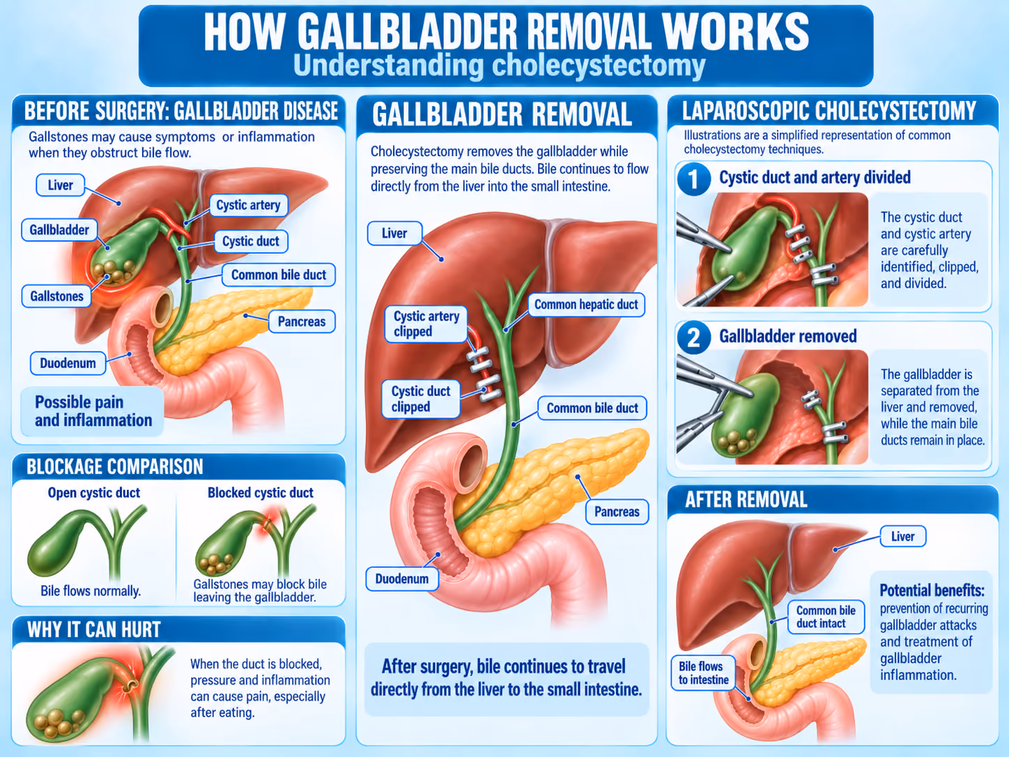 Infographie médicale expliquant l'ablation laparoscopique de la vésicule biliaire, montrant les calculs biliaires, le canal et l'artère cystiques, le clampage chirurgical et l'ablation de la vésicule biliaire, et le flux biliaire après l'opération.