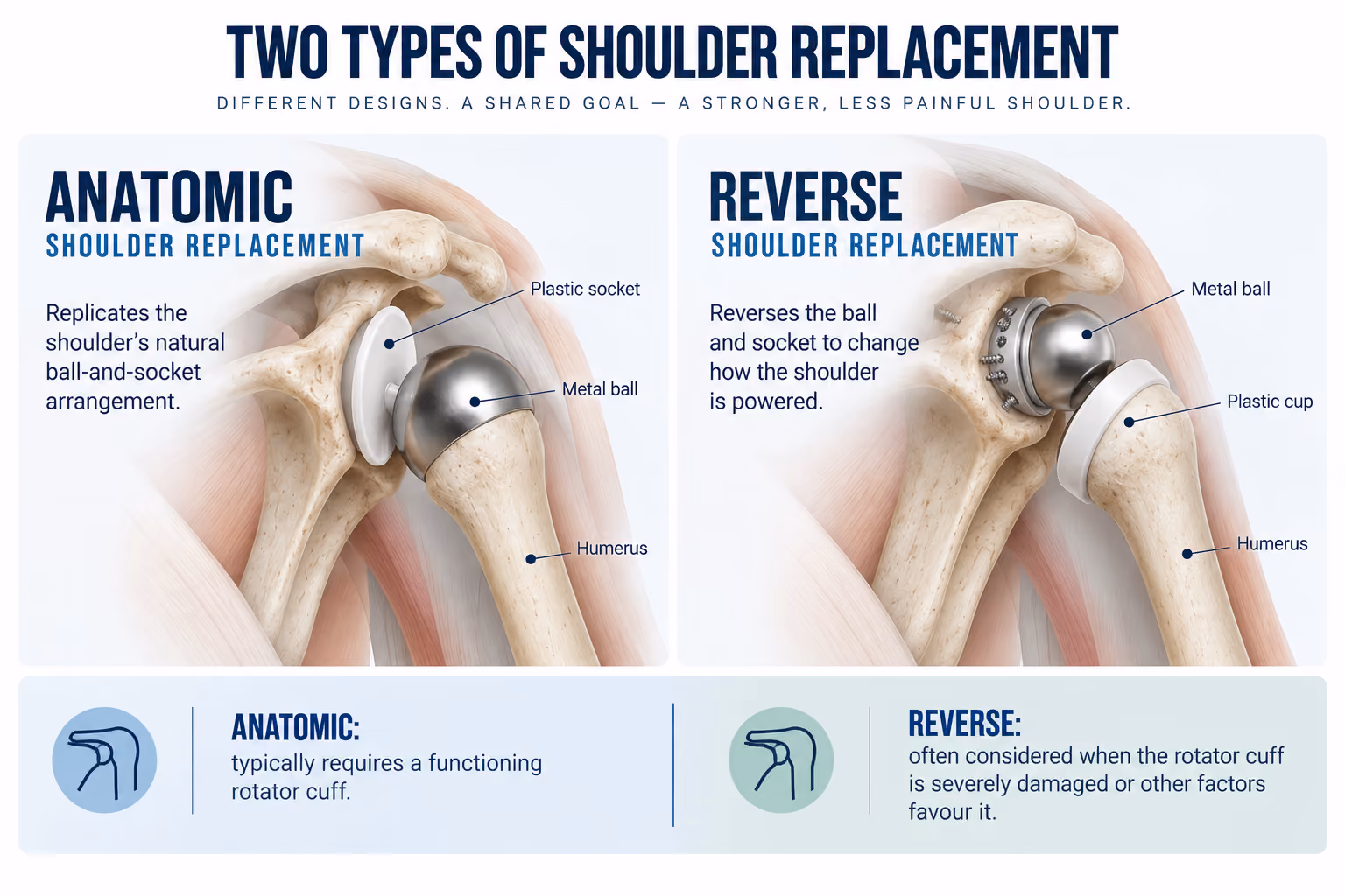 Illustration comparing anatomic and reverse shoulder replacement surgery, showing the position of the metal ball and plastic socket implants in each procedure.