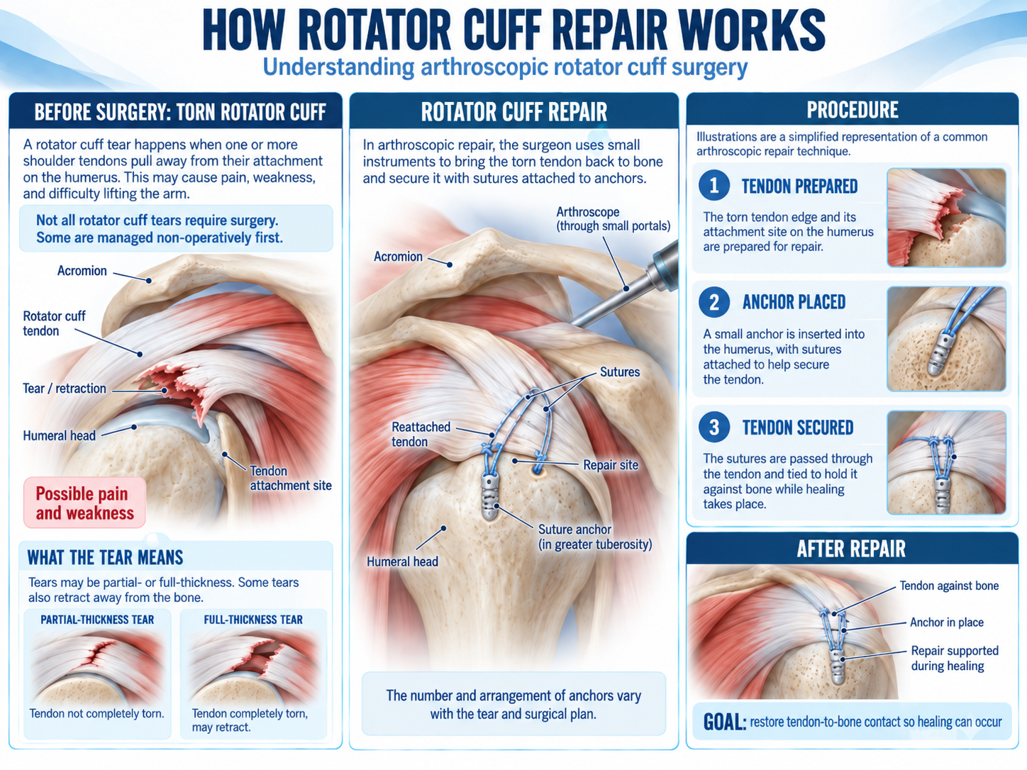Rotator cuff repair infographic showing a torn shoulder tendon, arthroscopic suture anchors in the greater tuberosity, and tendon reattachment to bone.