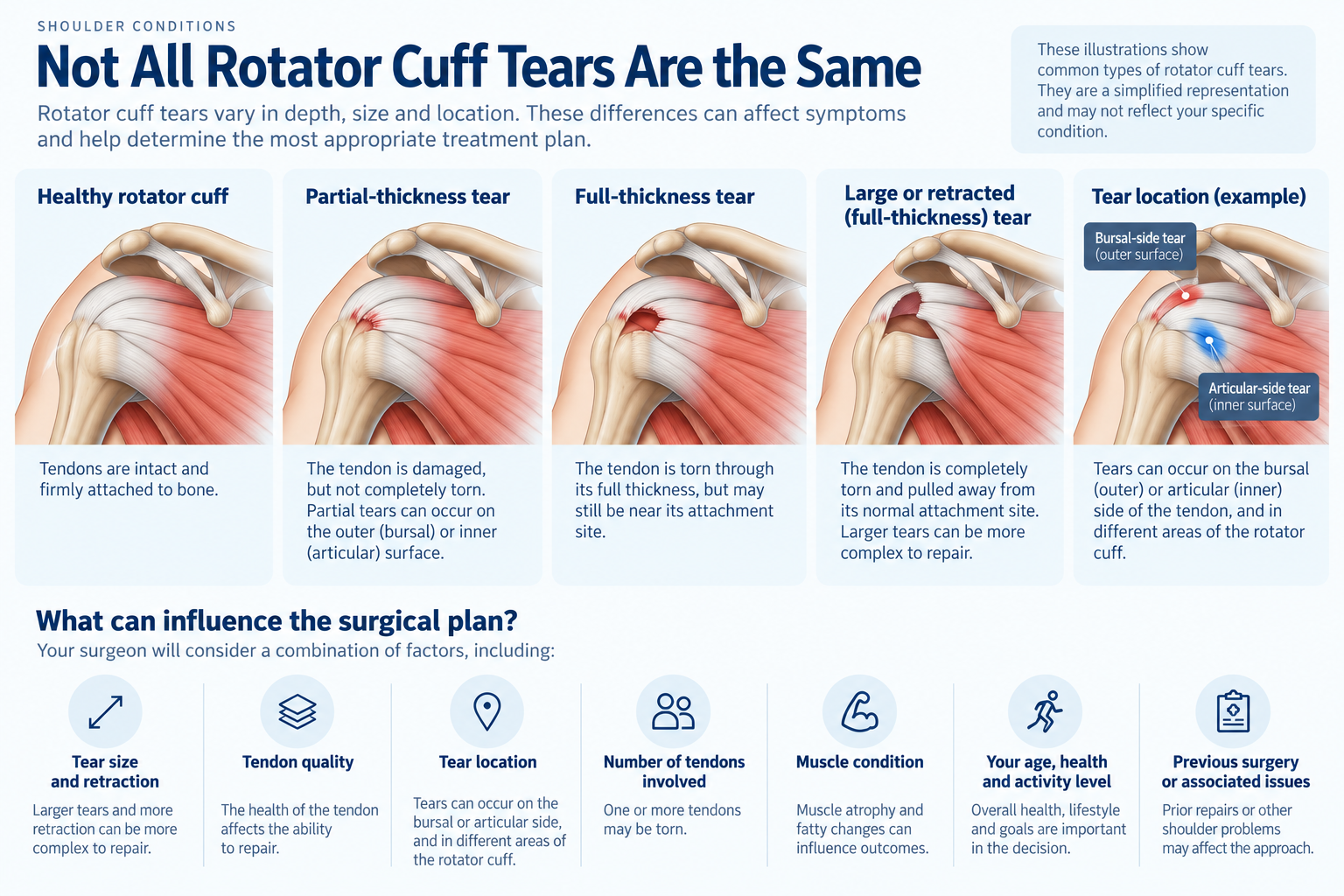 Rotator cuff tear infographic comparing partial-thickness, full-thickness, large or retracted tears, tear location, and factors that influence shoulder surgery planning.