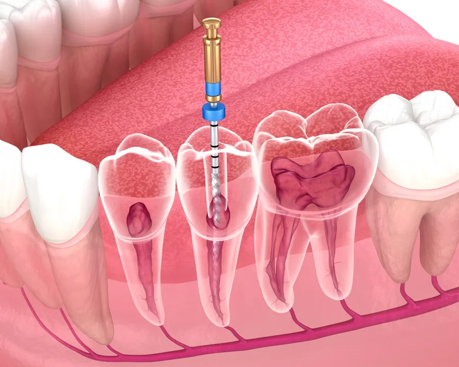 root_canal_fort_walton_beach_treatment_dentist_illustration