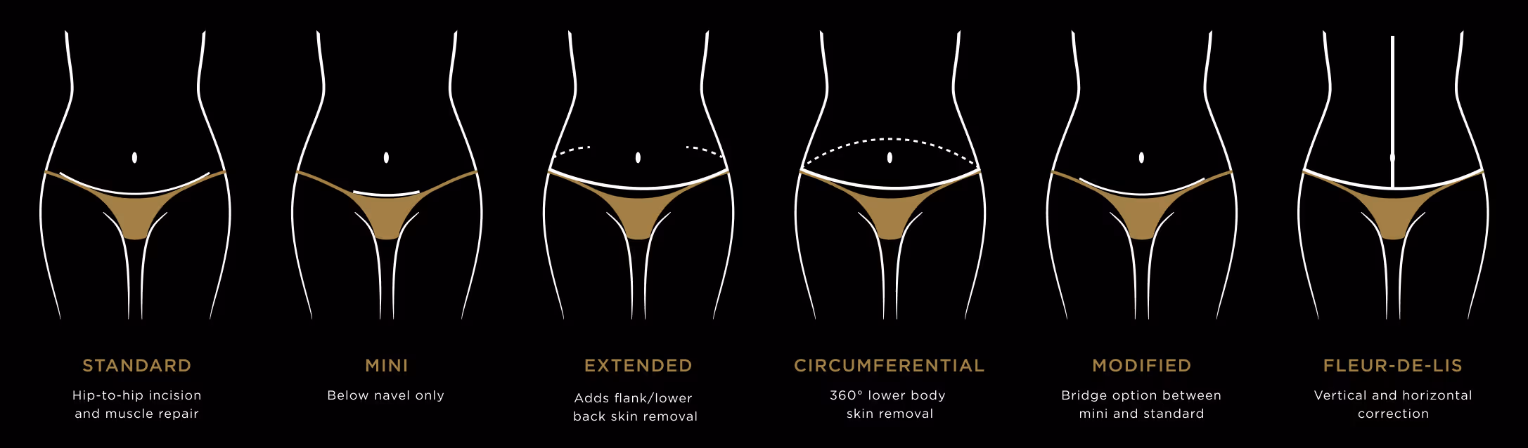 Tummy Tuck incision techniques