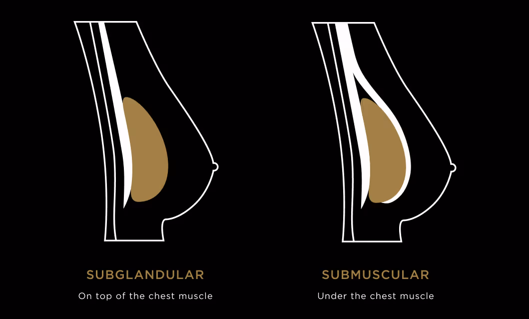 Breast Augmentation implant options