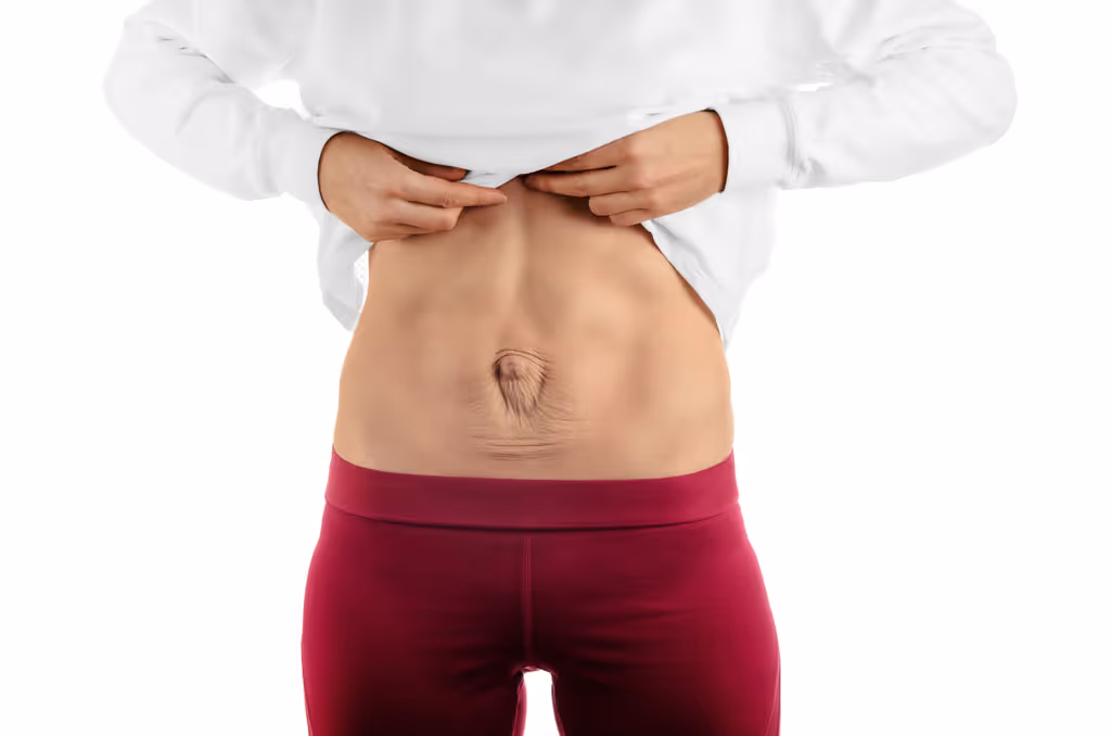 Diastasis Recti After Pregnancy: Why Crunches Won’t Flatten Your Stomach (and What Will)