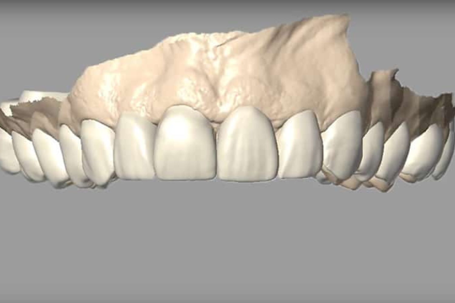 Digital diagnostic wax-up designed at AMR Dental Ceramics, Las Vegas dental lab