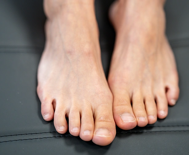 Ingrown Toenail Surgery