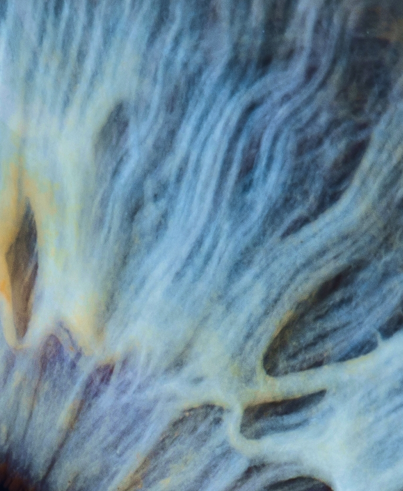 Interview with co-founder of ForSight Robotics: ‘Cataract prevalence is expected to double by 2050’