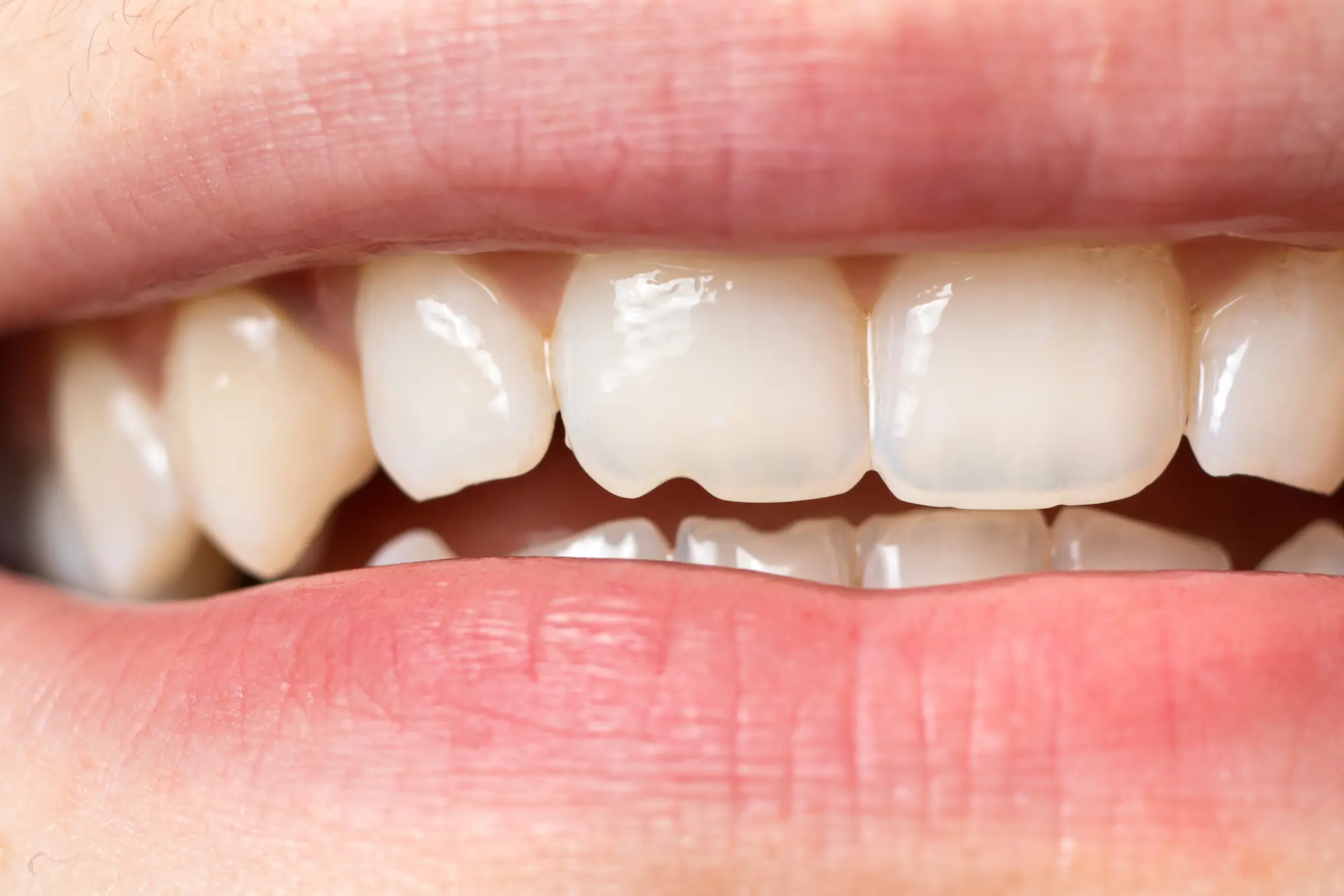 Chipped tooth repair at Goshen Smiles in Goshen, IN