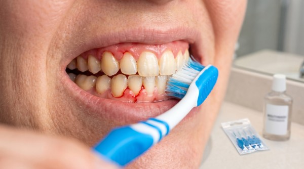 Do You Still Need Dental Cleanings If You Brush and Floss?