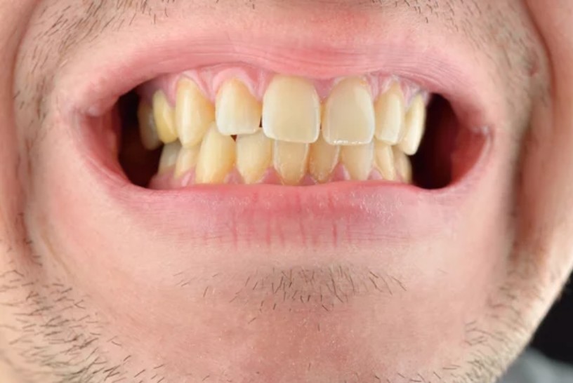 Why Your Teeth May Look More Yellow As You Get Older