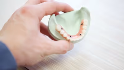 This is a snapshot of one of the most expensive dental treatments available in dentistry today. Four dental implants are used to secure a dental bridge of 12 teeth to restore the function and aesthetics of your teeth.