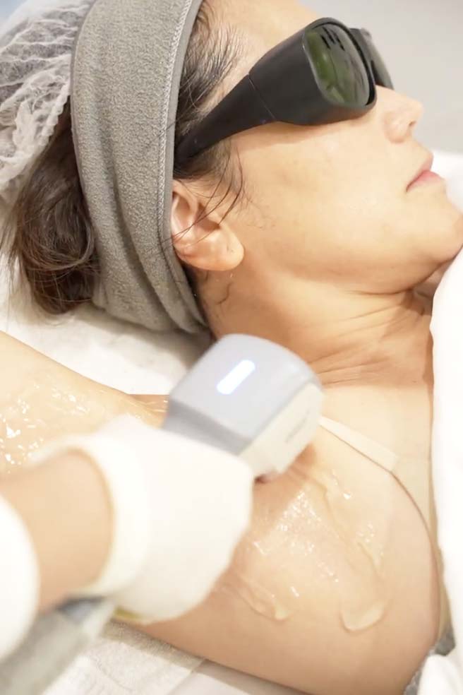 Laser hair removal along the neck, client wearing protective eyewear
