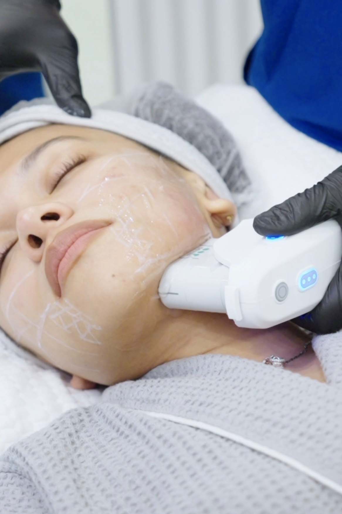 Ulthera ultrasound applicator moved along a client's jawline