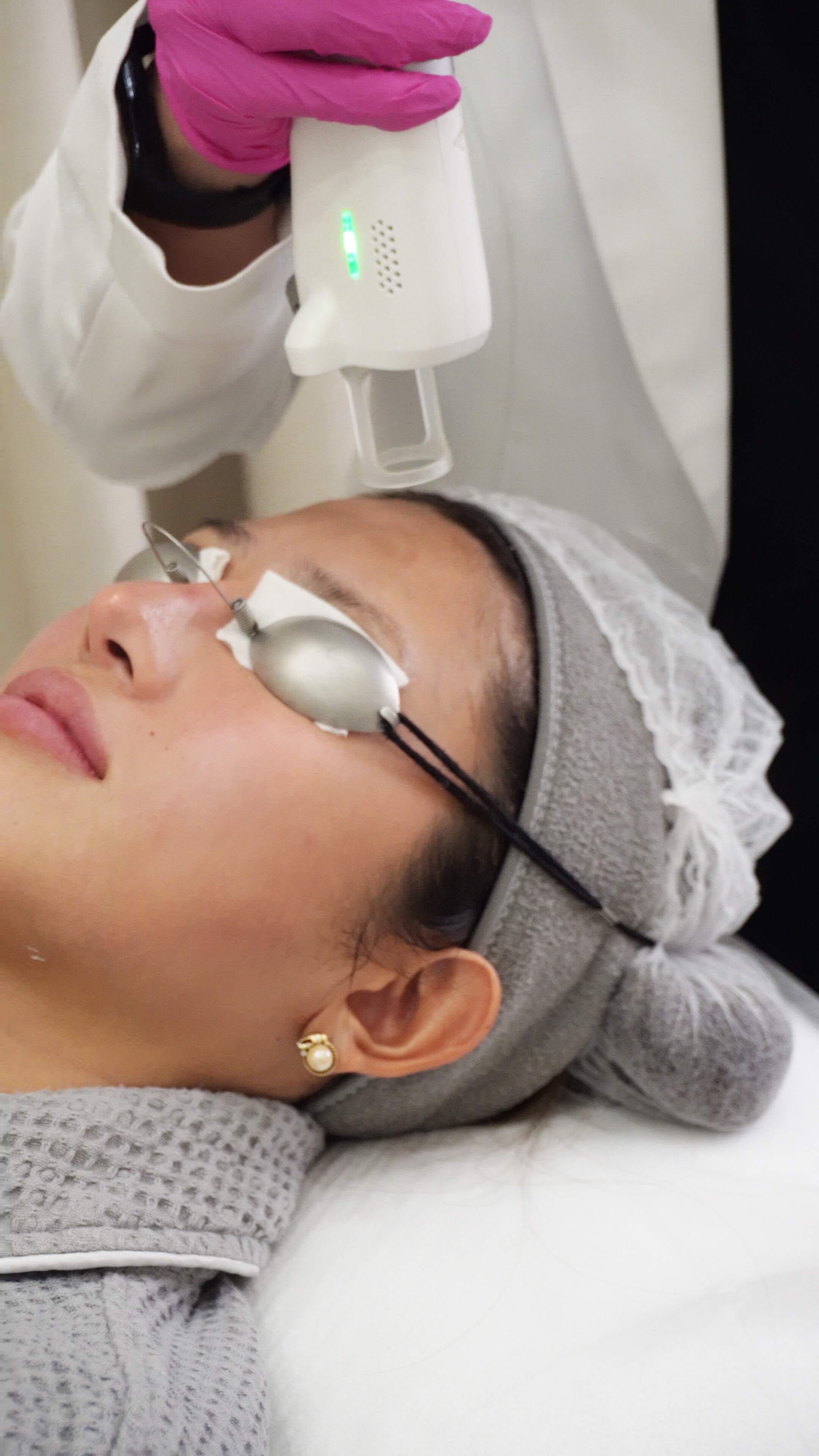Laser treatment on the face, client wearing protective eye shields