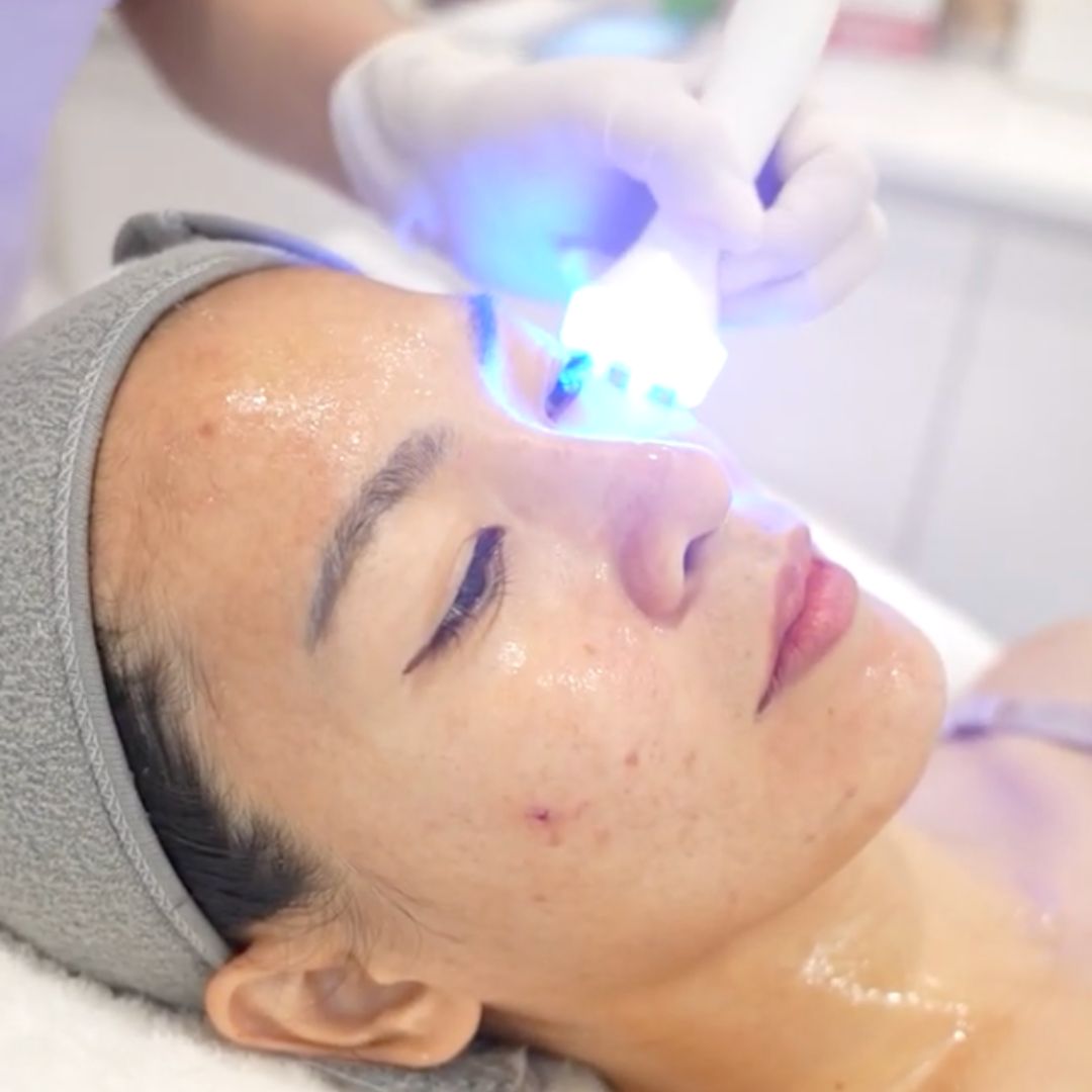 Handheld facial device with blue light applied to a client's face