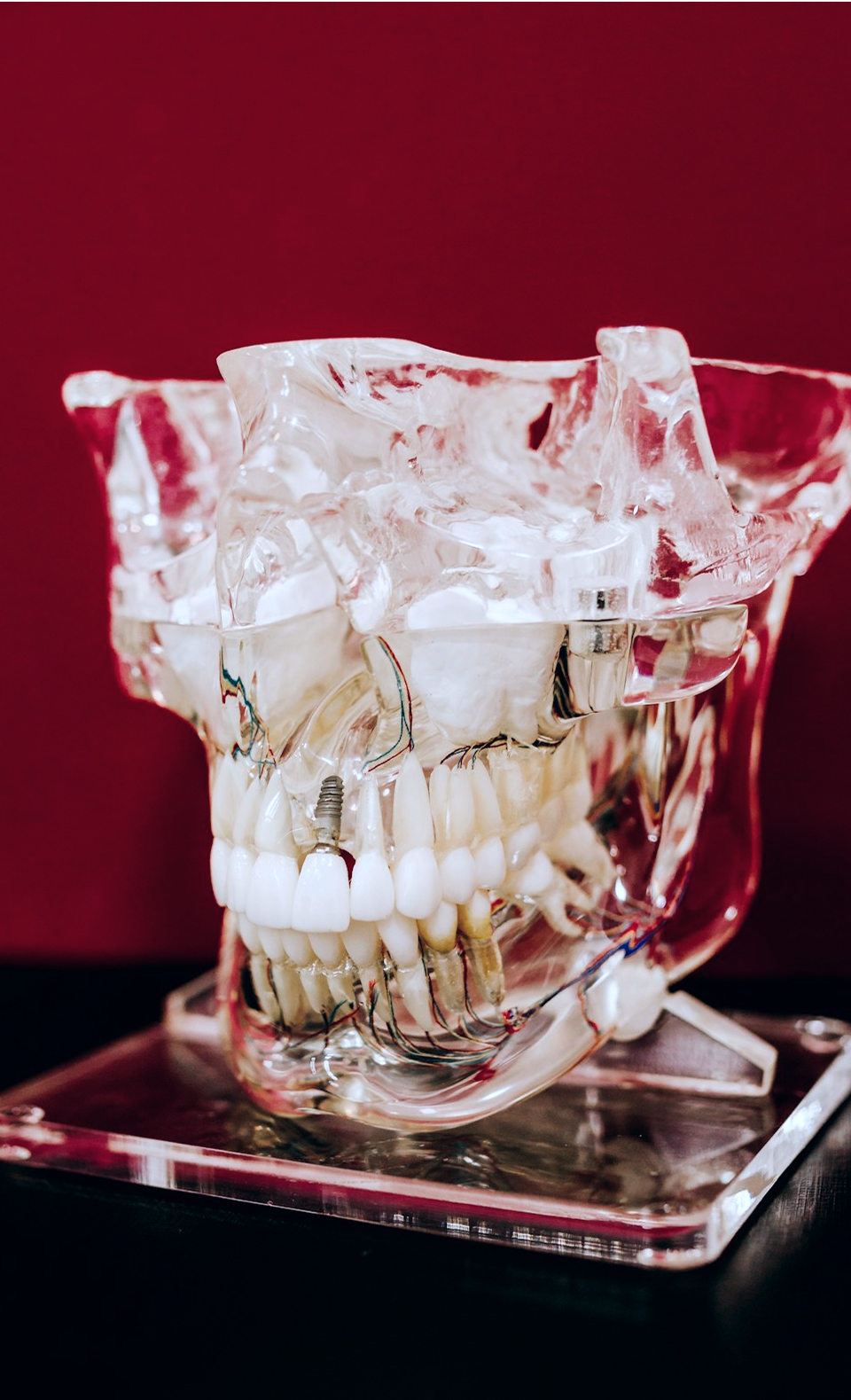 Transparent dental model showing teeth, jaw, and dental implants