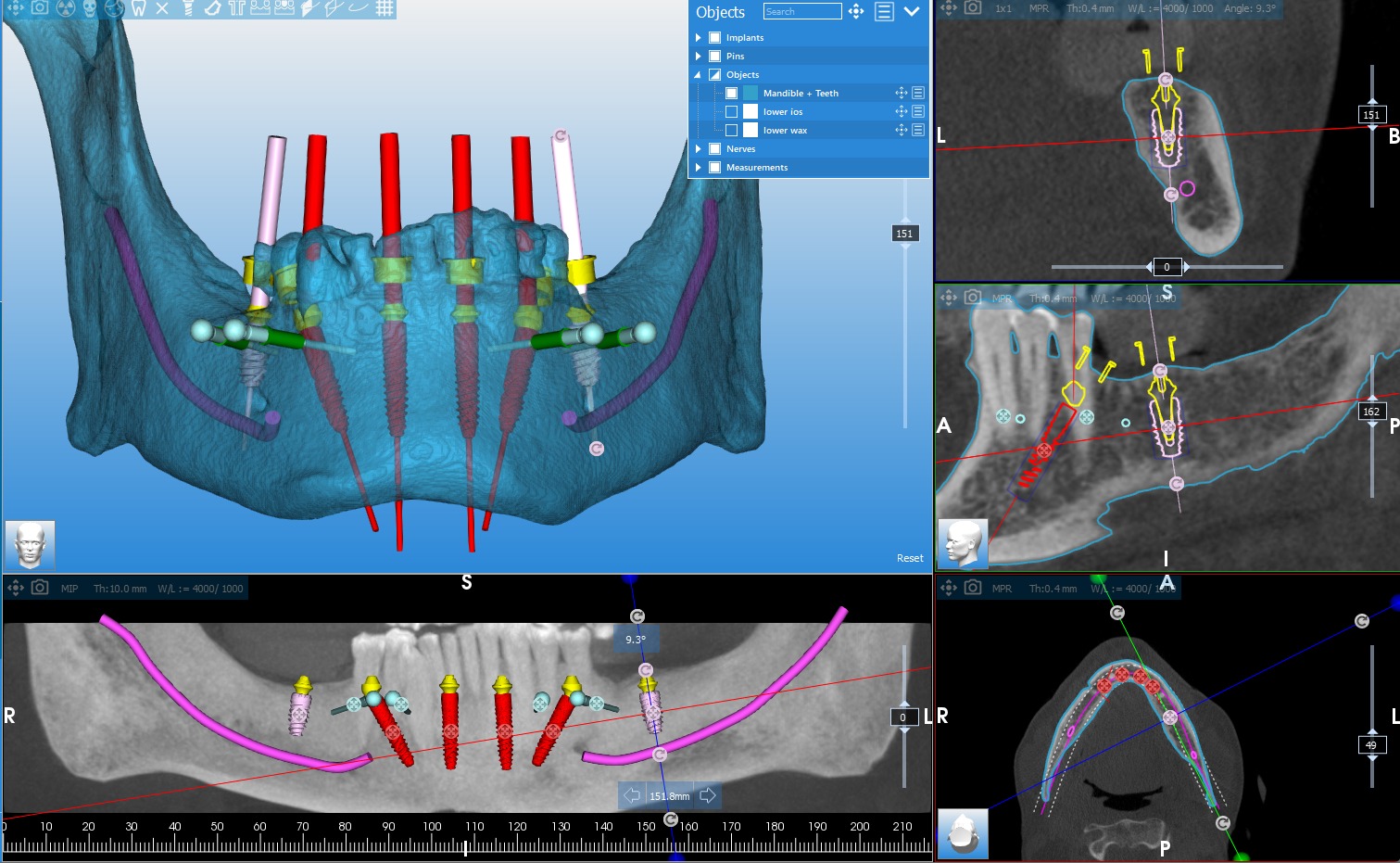 Dental implant surgical planning with 3D CT scan and virtual placement
