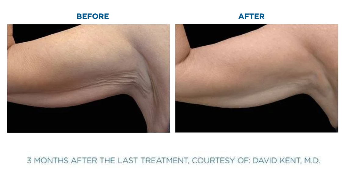 Before and after photos showing a person's upper arm with loose, wrinkled skin on the left and smoother, firmer skin on the right, taken three months after the last treatment.