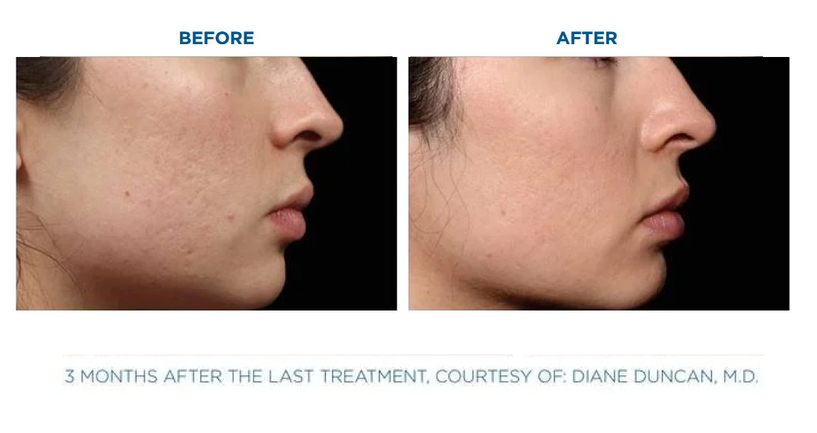 Side-by-side profile photos of a woman's cheek showing skin texture before and smoother skin after treatment, taken three months apart.