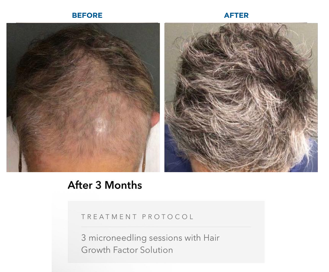 Before and after photos of a person's scalp showing hair regrowth after 3 microneedling sessions with Hair Growth Factor Solution over 3 months; the before photo shows significant thinning, and the after photo shows thicker, fuller hair.