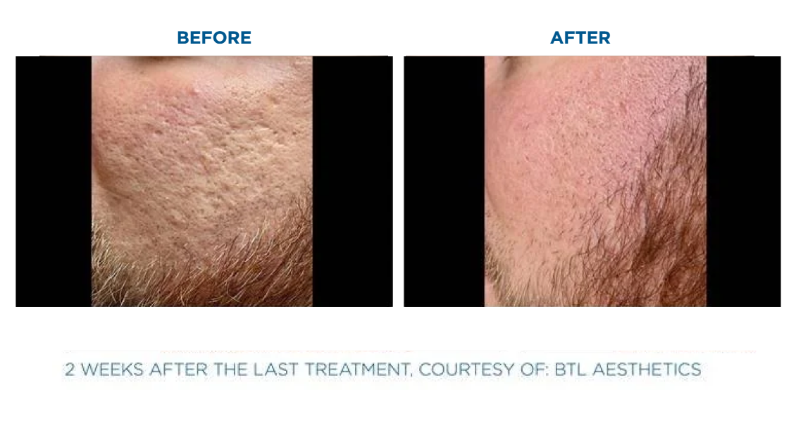 Side-by-side comparison of a man's cheek before and after skin treatment showing reduced acne scars and smoother skin two weeks after the last treatment.