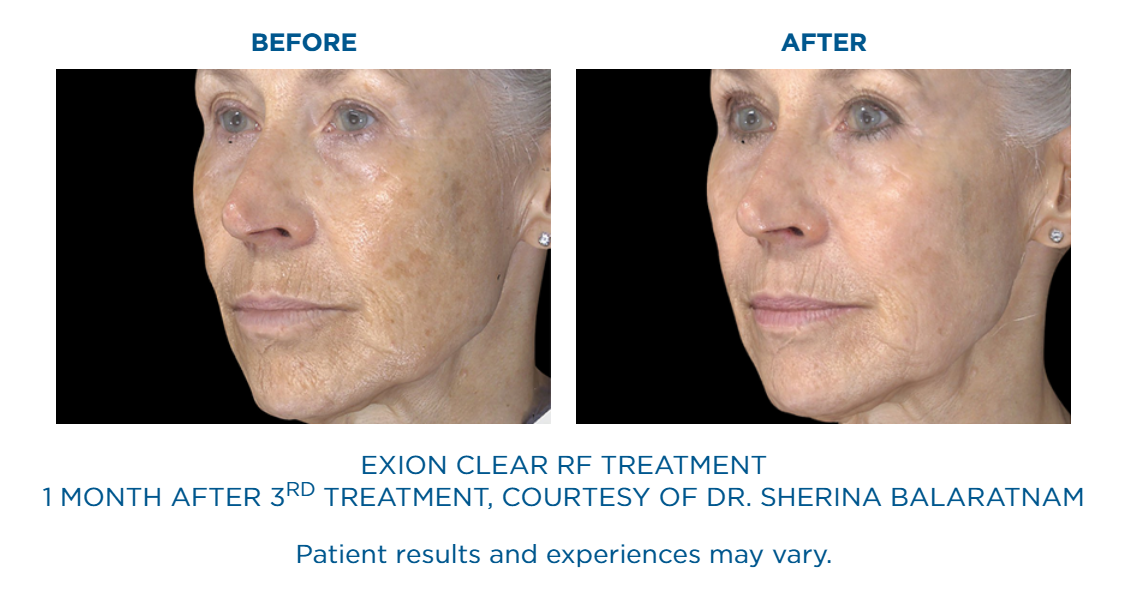 Side-by-side before and after photos of an elderly woman's face showing improved skin tone and reduced dark spots one month after the third Exion Clear RF treatment.