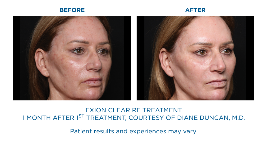 Side-by-side before and after images of a woman's face showing reduced redness and smoother skin one month after Exion Clear RF treatment.