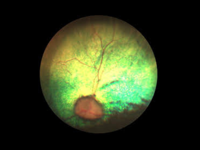 An image taken with a machine that shows retinal disease.