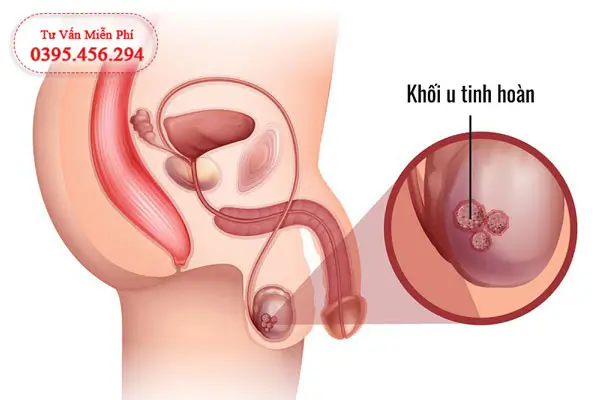 Đau tinh hoàn bên phải nguyên nhân do Ung thư tinh hoàn