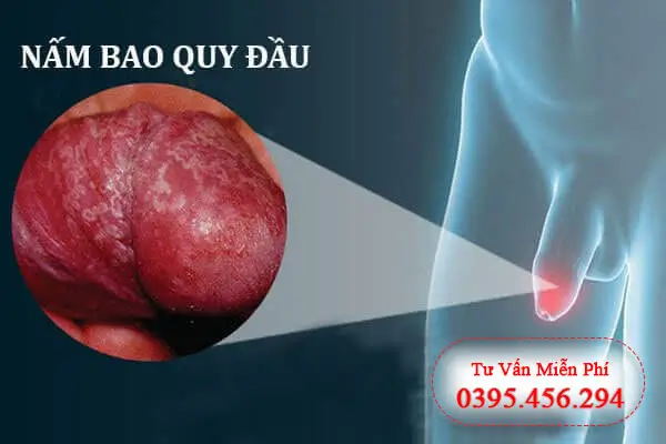 Nguyên nhân dẫn đến nhiễm nấm Candida ở dương vật