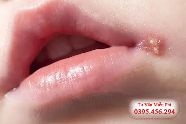 Hình ảnh và triệu chứng mụn rộp sinh dục ở miệng