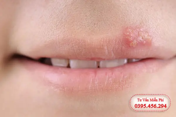 Hình ảnh và triệu chứng mụn rộp sinh dục ở miệng giai đoạn nhiễm trùng khởi phát