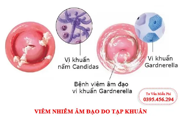 Viêm nhiễm âm đạo do tạp khuẩn