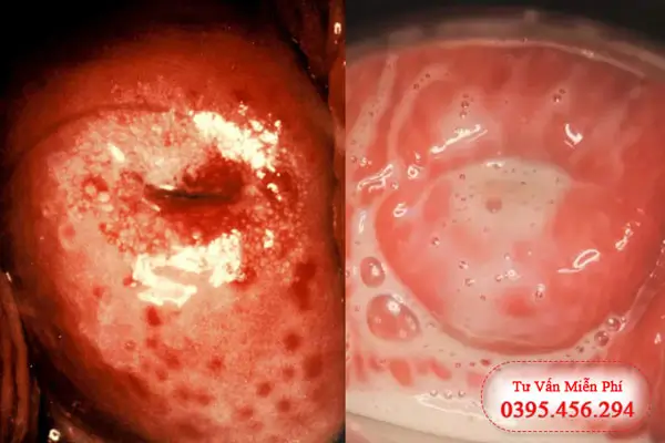 Hình ảnh bệnh phụ khoa viêm lộ tuyến cổ tử cung