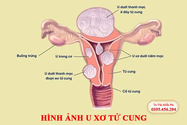 Hình ảnh u xơ tử cung